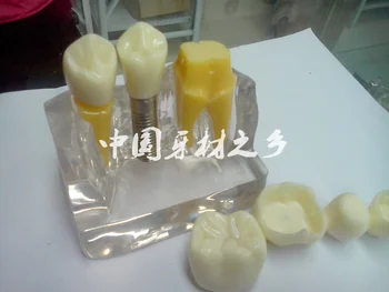 Стоматологические материалы Демонстрация разрушения ногтя оральная четырехкратная модель посадки прозрачного зуба Бесплатная доставка